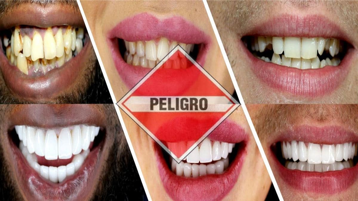 Última peligrosa 'moda': ¿sabes lo que es el 'Turkey Teeth'?